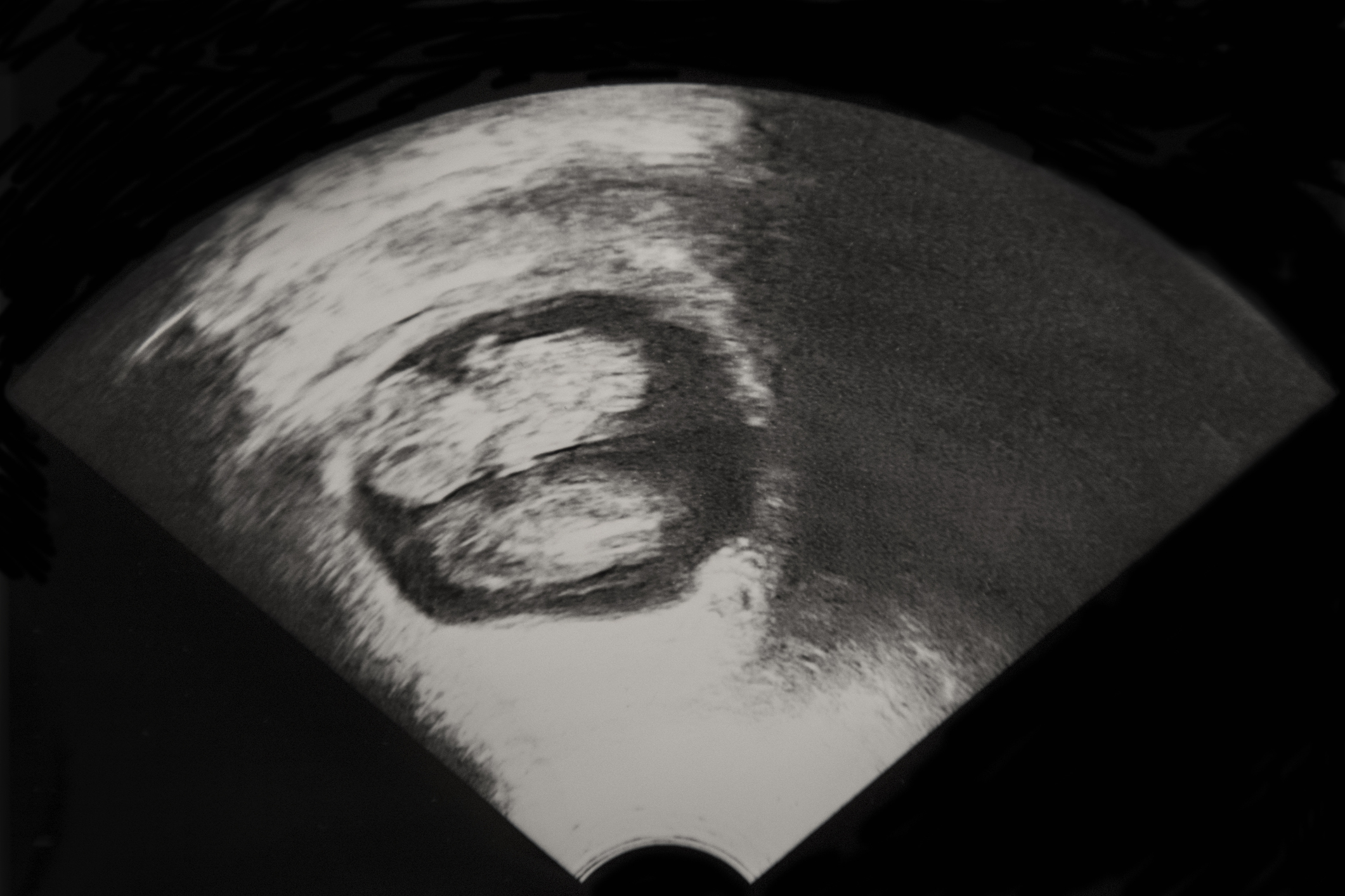 Ultrasound Pictures Of Identical Twins
